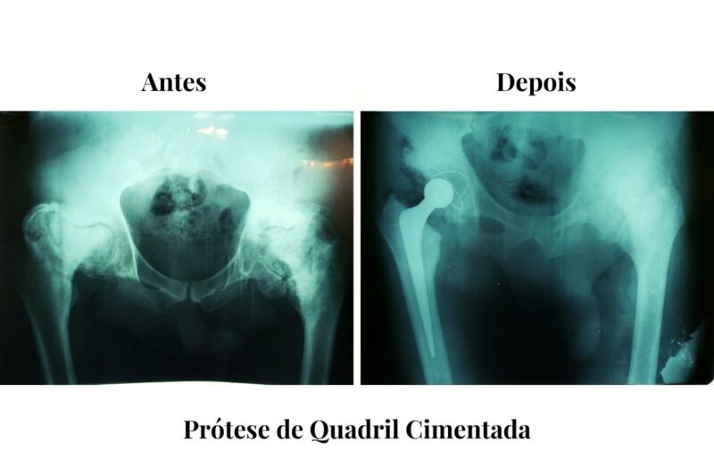 Dr-jose-marcelo-protese-cimentada