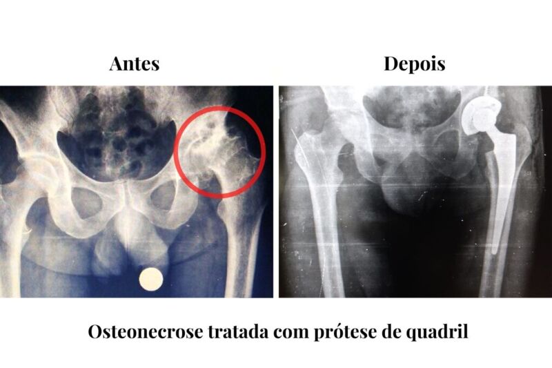 dr-jose-marcelo-tratamento-osteonecrose-quadril