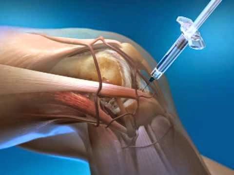 Quanto tempo dura o efeito de uma injeção no joelho?