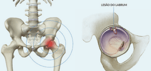 Lesão labral do quadril